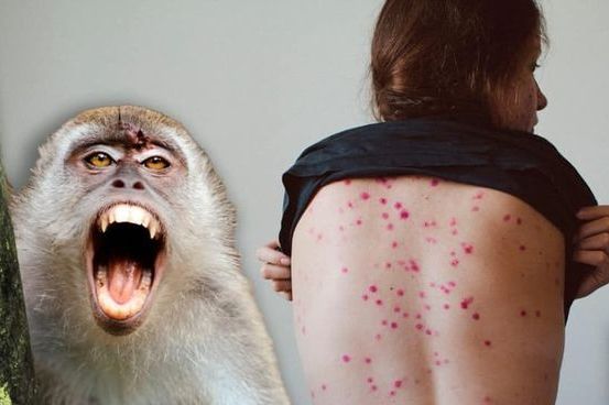 Ya se registró el primer caso de la Viruela del Mono en Sinaloa. 
